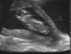 怀孕 检查 B超 胎儿