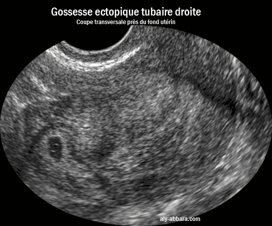 B超 胚胎 看到没 好小啊