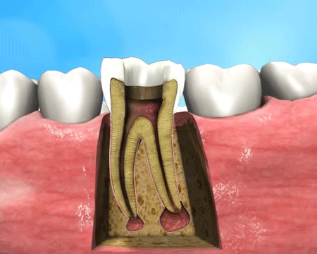 口腔 牙齿 蛀牙 治疗