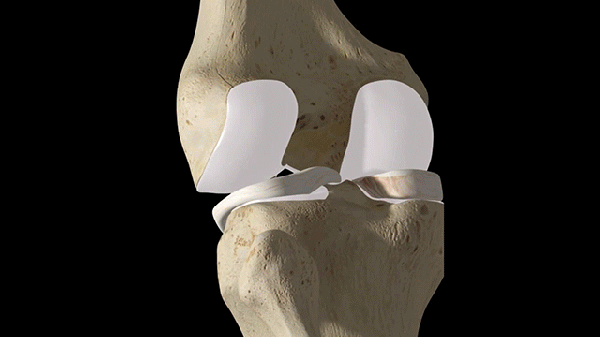 模拟  膝关节  治疗  修复