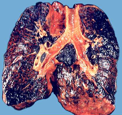 烟民 肺部 黑色 癌症